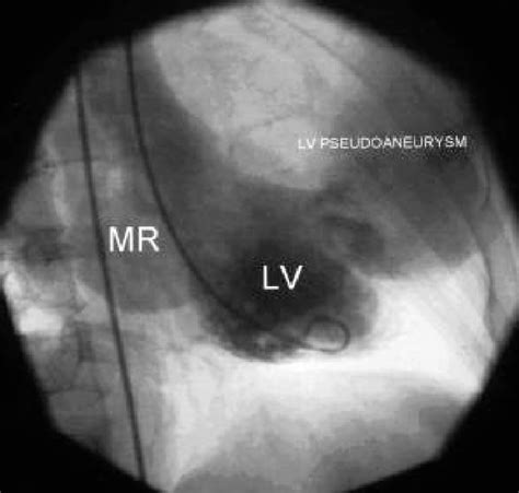 lv ventriculogram.